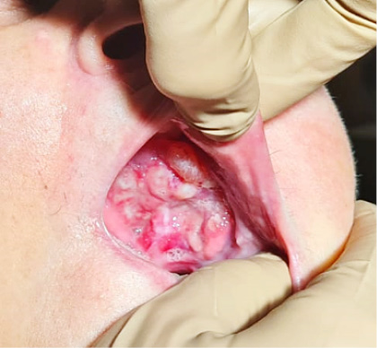 Splot Batsona - aspekty kliniczne i anatomiczne