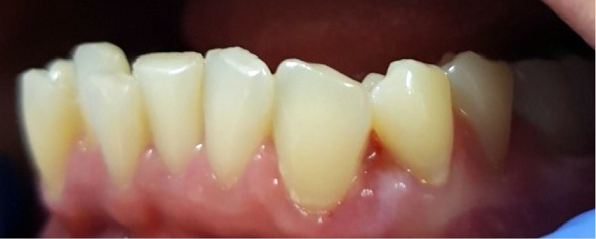 TPS_6_21_periodontologia_choroby_blony_sluzowej_NADZIASLAK_PRZYPADEK_KLINICZNY_FOT_5