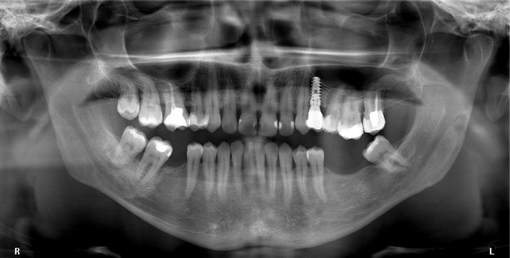 TPS_6_21_chirurgia_i_implantologia_REGENERACJA_TKANKI_MIEKKIEJ_I_TWARDEJ_FOT_2