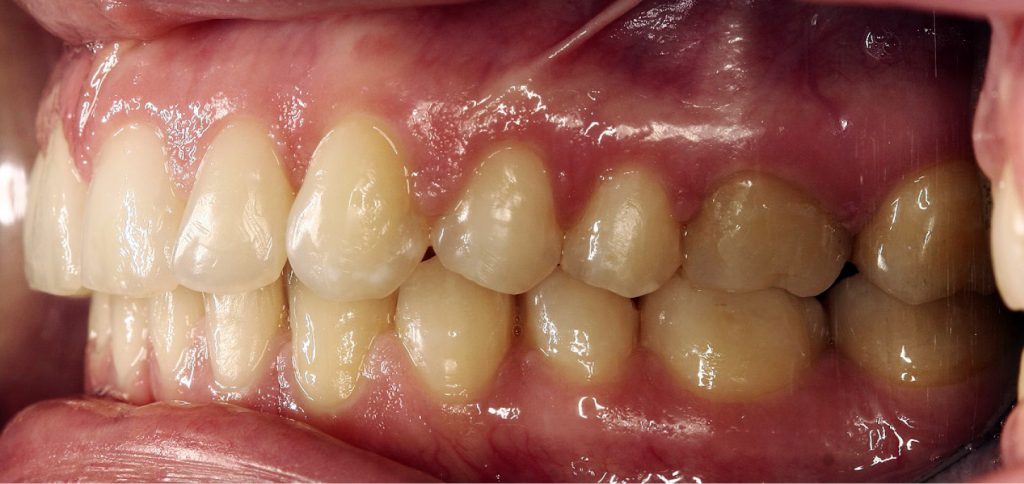 TPS_7-8_21_ortodoncja_katarzyna_pusulka_NIEPRAWIDLOWOSCI_ZGRYZU_CZYNNIK_BRUKSIZMU_25