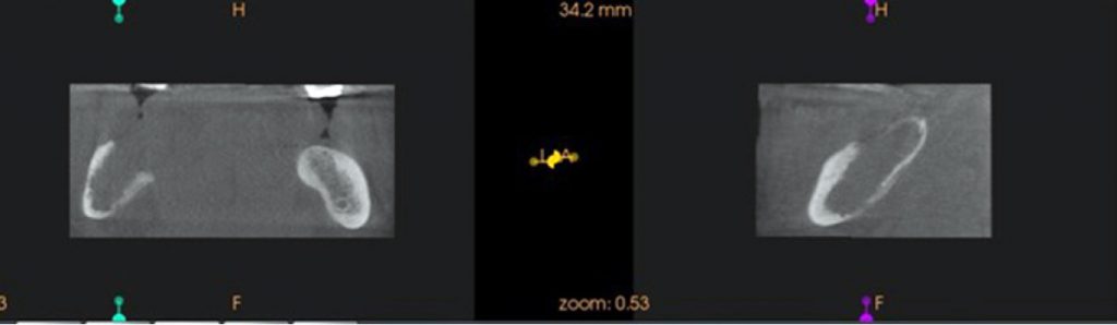 TPS_7-8_21_chirurgia_i_implantologia_PRZERZUT_RCC_DO_ZUCHWY_1