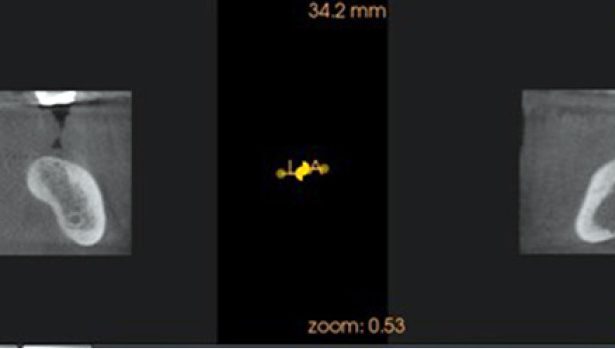 TPS_7-8_21_chirurgia_i_implantologia_PRZERZUT_RCC_DO_ZUCHWY_1