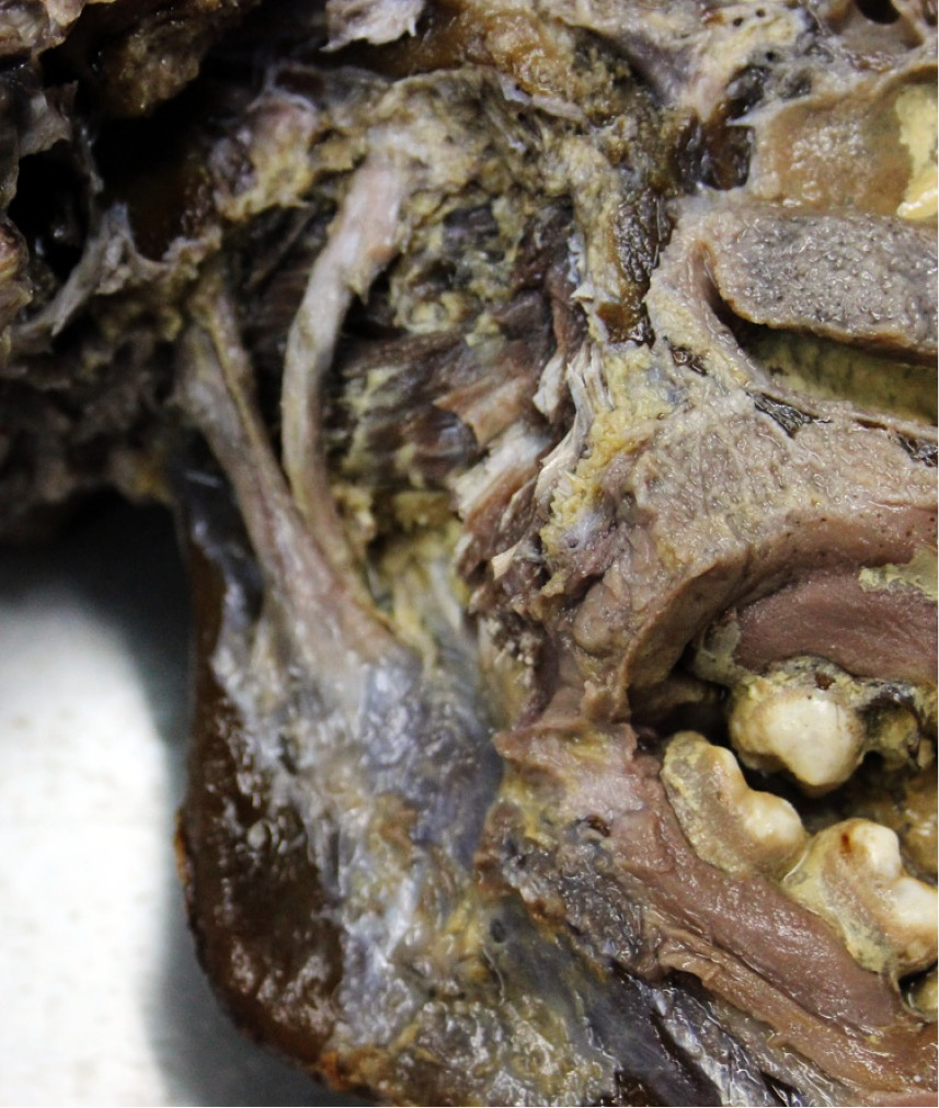 TPS_7-8_21_protetyka_dysfunkcje_narzadu_zucia_ROLA_WIEZADLA_KLINOWO_ZUCHWOWEGO_2