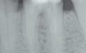 EWP_3_13_maciej_zarow_ENDOPROTETYKA_OPIS_PRZYPADKU_KLINICZNEGO_FOT_3