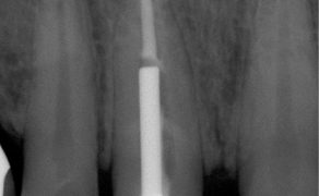 EWP_3_13_jurgen_manhart_WKLADY_KORZENIOWE_Z_MATERIALU_KOMPOZYTOWEGO_FOT_2