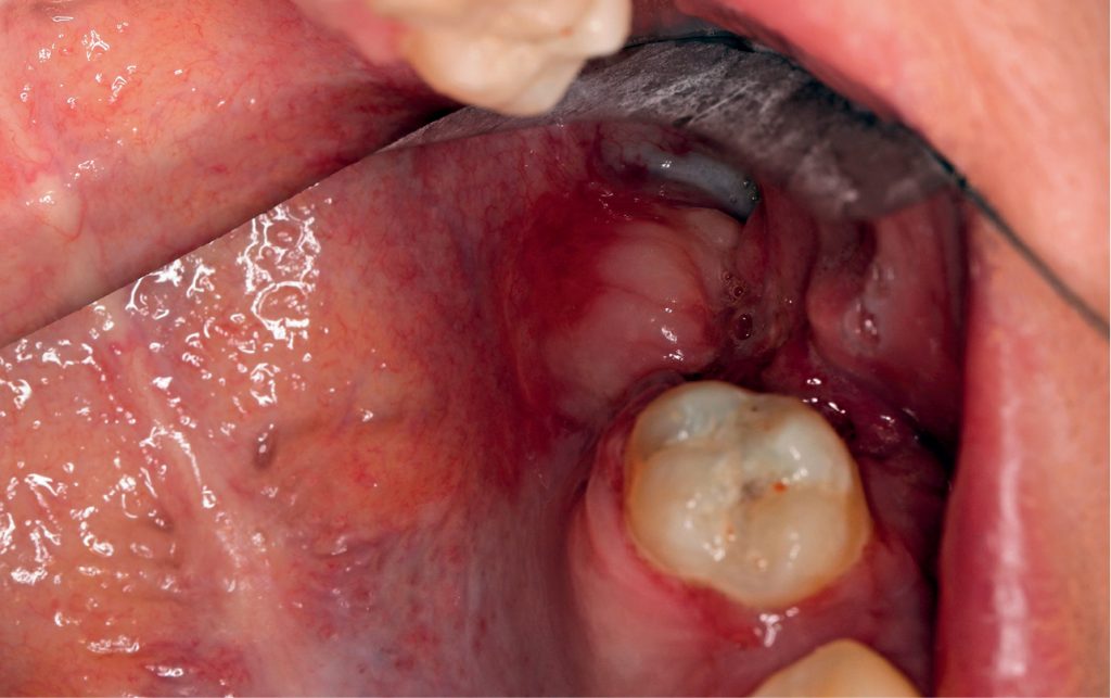 TPS_9_21_chirurgia_implantologia_PRZETOKA_USTNO_ZATOKOWA_FIBRYNA_BOGATOPLYTKOWA_FOT_7