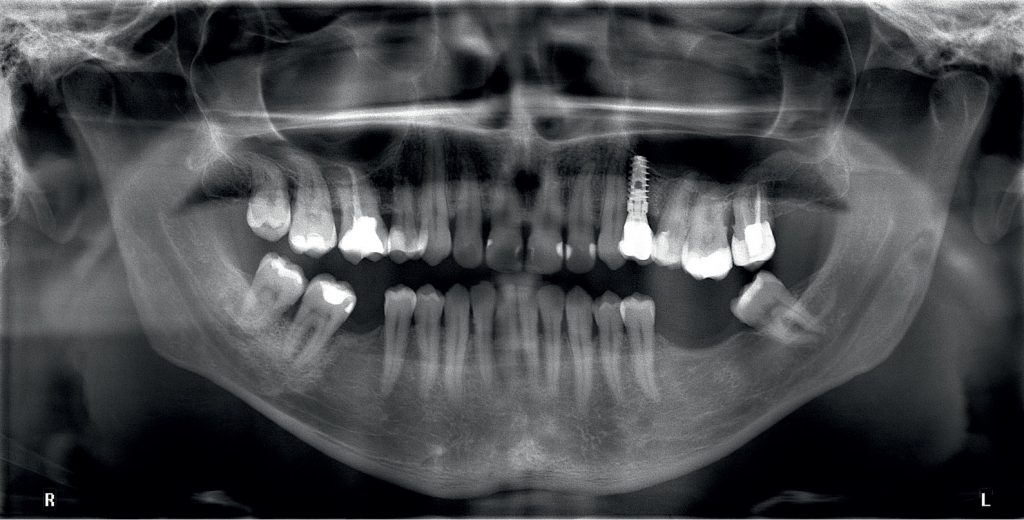 TPS_9_21_TKANKA_MIEKKA_I_TWARDA_PERIIMPLANTITIS_LASER_DIODOWY_FOT_2