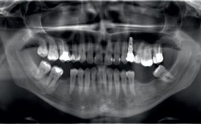 TPS_9_21_TKANKA_MIEKKA_I_TWARDA_PERIIMPLANTITIS_LASER_DIODOWY_FOT_2