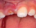 Postępowanie kliniczne w przypadku znacznej intruzji zęba 11