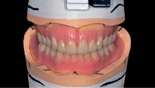 Innowacje w dziedzinie overdenture