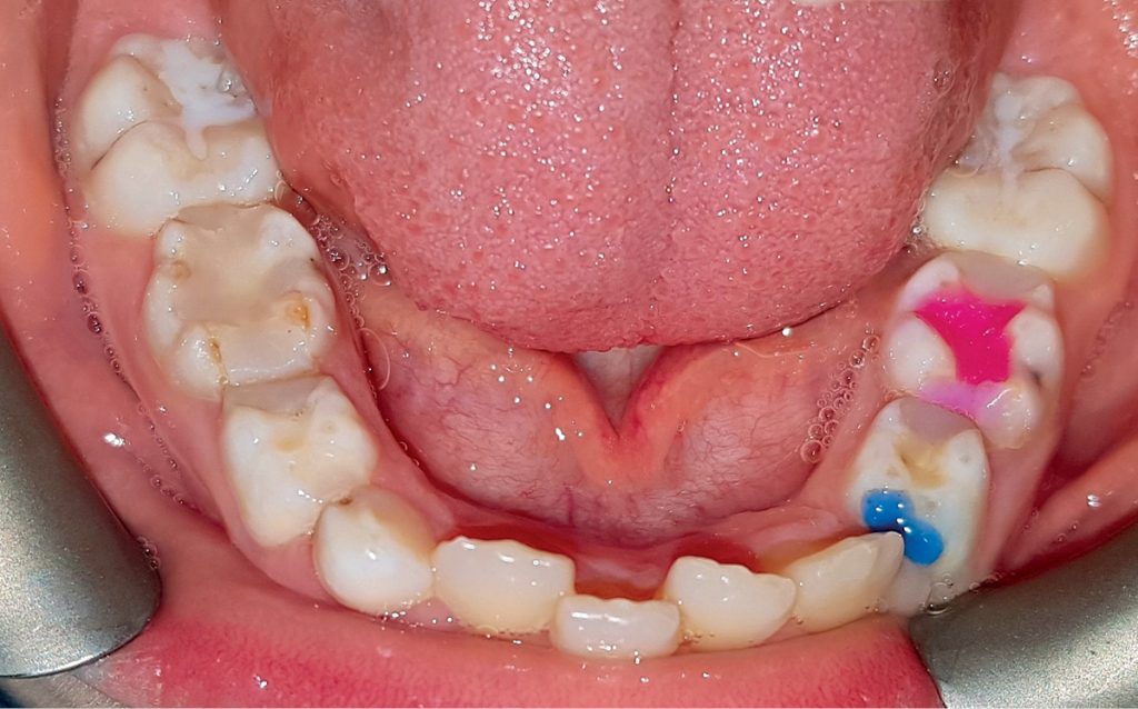 TPS_10-11_21_stomatologia_wieku_rozwojowego_Ewa_Reczek_Jakub_Ligeza_PROCHNICA_U_DZIECI_FOT_3