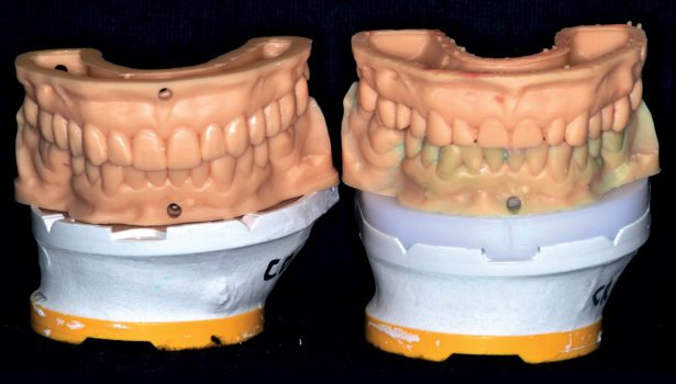 rekonstrukcja oraz podniesienie zgryzu