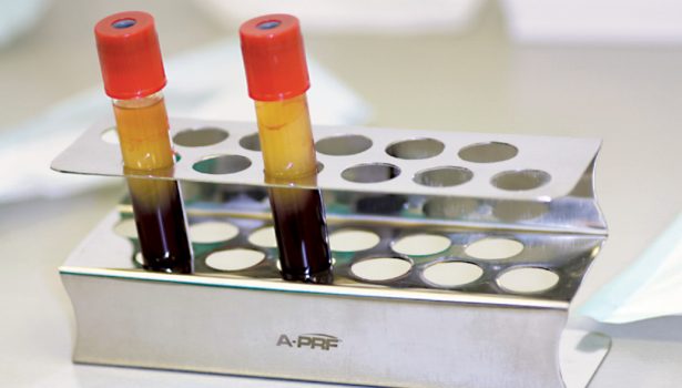 TPS_10-11_21_chirurgia_i_implantologia_RESEKCJA_WIERZCHOLKA_KORZENIA_FOT_11