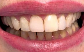 Wykorzystanie techniki iniekcyjnej