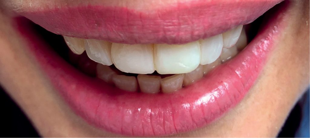 TPS_10-11_21_stomatologia_zachowawcza_z_endodoncja_LICOWKI_KOMPOZYTOWE_TECHNIKA_INIEKCYJNA_FOT_5