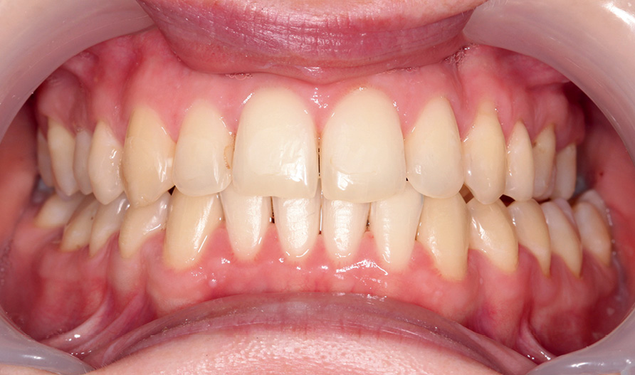 TPS_10-11_21_ortodoncja_PRZEDWCZESNA_UTRATA_KLA_FOT_14