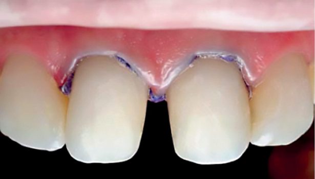 cementowanie licówek ceramicznych