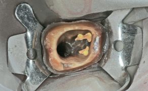 EWP_2_13_Olivier_Etienne_Jean-Claude_Schoeffler_MOCOWANE_ADHEZYJNIE_WKLADY_I_ZREBY_FOT_2