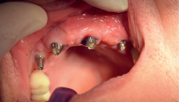 TPS_12_21_periodontologia_choroby_blony_sluzowej_FOTOAKTYWNA_DEZYNFEKCJA_PERIIMPLANTITIS_RYC_5