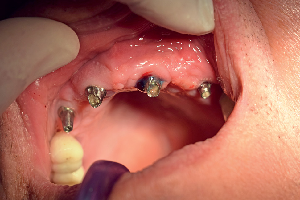 TPS_12_21_periodontologia_choroby_blony_sluzowej_FOTOAKTYWNA_DEZYNFEKCJA_PERIIMPLANTITIS_RYC_5