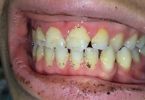 TPS_12_21_badania_interdyscyplinarne_INFEKCYJNE_ZAPALENIE_WSIERDZIA_2