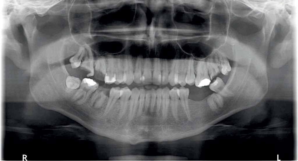 TPS_12_21_stomatologia_zachowawcza_endodoncja_Lukasz_Balcerzak_MATERIALY_KRZEMIANOWO-WAPNIOWE_FOT_1