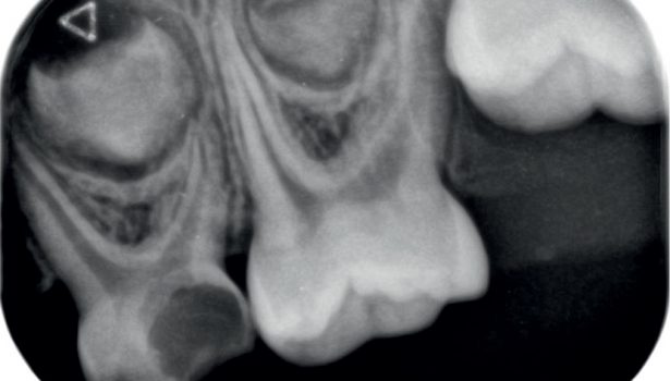 TPS_12_21_stomatologia_zachowawcza_endodoncja_Lukasz_Balcerzak_MATERIALY_KRZEMIANOWO-WAPNIOWE_FOT_9