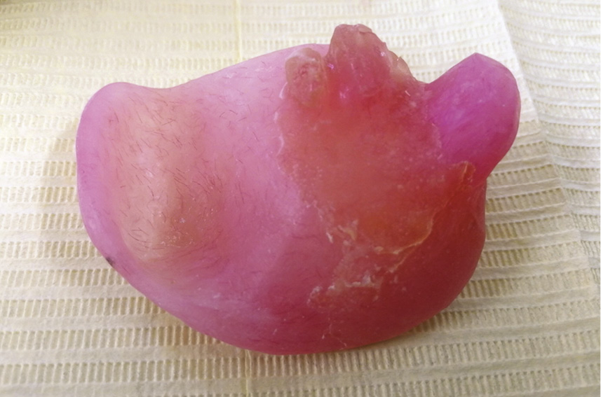 TPS_12_21_temat_numeru_POSTEPOWANIE_PO_RESEKCJI_SZCZEKI_FOT_5