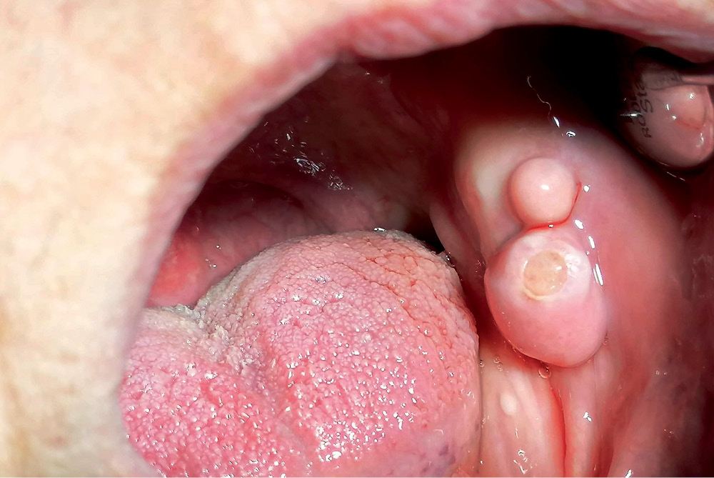 TPS_12_21_periodontologia_choroby_blony_sluzowej_Marlena_Karwat_WLOKNIAK_BLONA_SLUZOWA_FOT_1