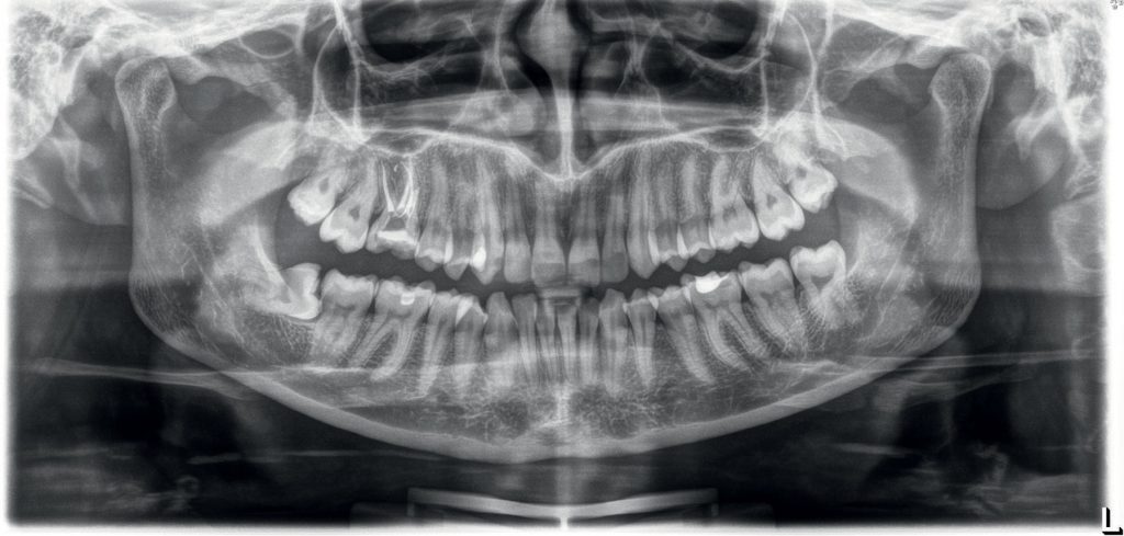 TPS_1-2_22_Katarzyn_Zwierzchowska_ADHEZYJNA_ODBUDOWA_ZEBOW_TRZONOWYCH_FOT_1