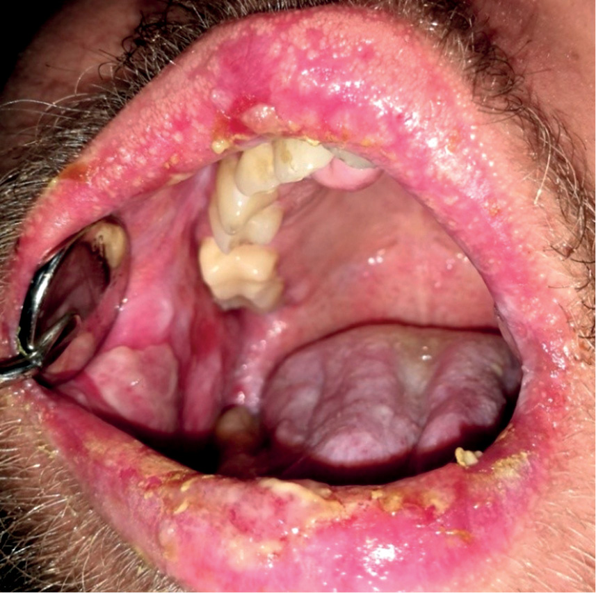 TPS_1-2_22_periodontologia_i_choroby_blony_sluzowej_OSTRA_BIALACZKA_LIMFOBLASTYCZNA_FOT_1_A