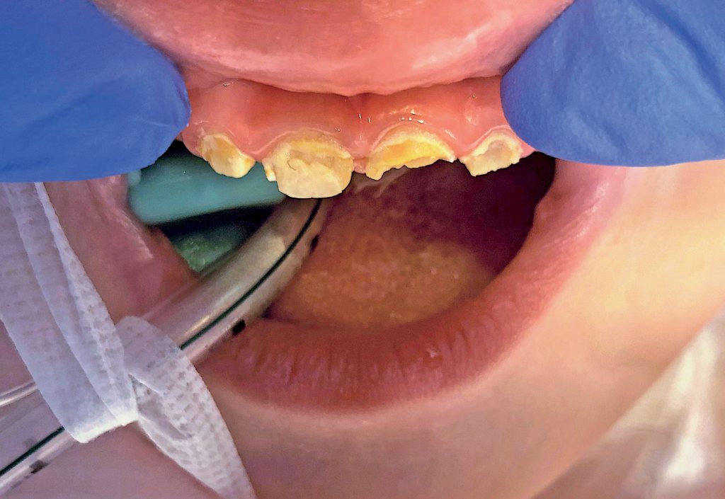 Próchnica wieku wczesnego