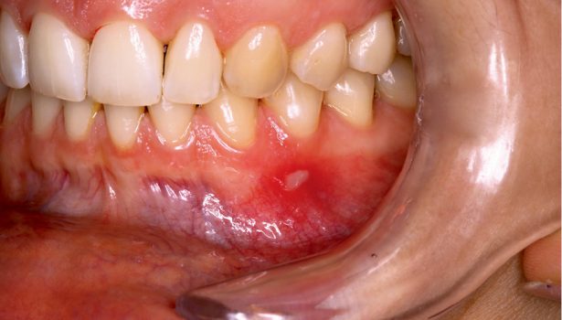 Rola fotobiomodulacji w chirurgii