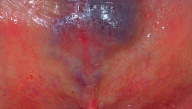 wykorzystanie lasera diodowego