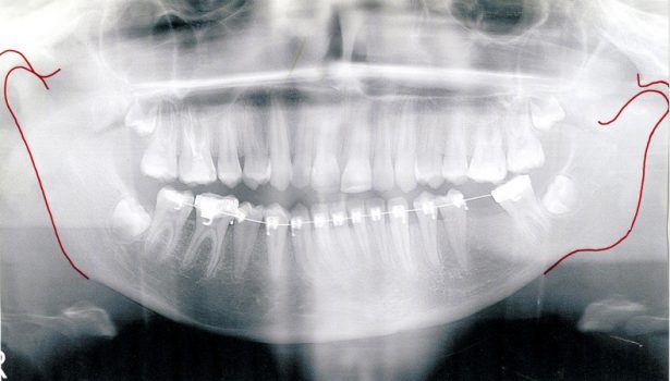 OWP_2_19_LECZENIE_ORTODONTYCZNO-CHIRURGICZNE_RYC_6