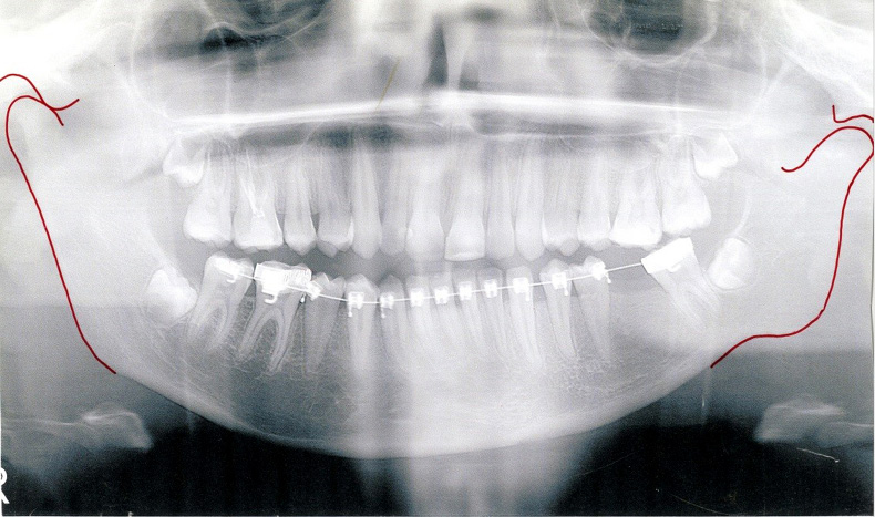 OWP_2_19_LECZENIE_ORTODONTYCZNO-CHIRURGICZNE_RYC_6