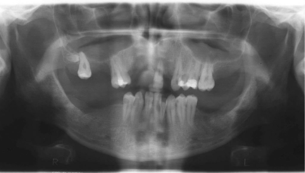 OWP_2_19_PACJENT_Z_BRAKIEM_13_ZEBOW_FOT_4