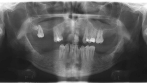 OWP_2_19_PACJENT_Z_BRAKIEM_13_ZEBOW_FOT_4