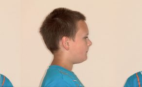 OWP_3_19_LECZENIE_PACJENTA_ROSNACEGO_Z_II_KLASA_SZKIELETOWA_FOT_2