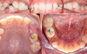 OWP_3_19_LECZENIE_PACJENTA_ROSNACEGO_Z_II_KLASA_SZKIELETOWA_FOT_3