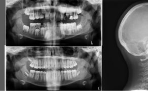 OWP_3_19_LECZENIE_PACJENTA_ROSNACEGO_Z_II_KLASA_SZKIELETOWA_FOT_4