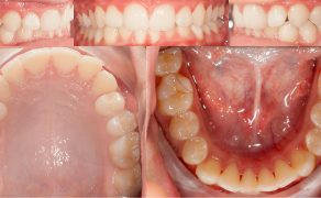 OWP_3_19_LECZENIE_PACJENTA_ROSNACEGO_Z_II_KLASA_SZKIELETOWA_FOT_5