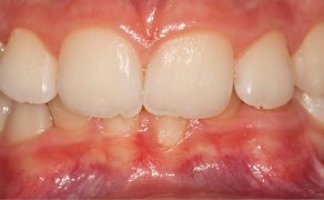 OWP_3_19_LECZENIE_PACJENTA_ROSNACEGO_Z_II_KLASA_SZKIELETOWA_FOT_7