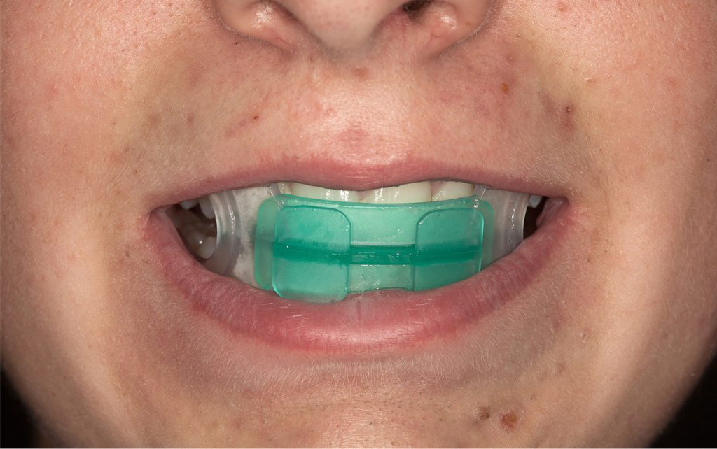 OWP_3_19_LECZENIE_PACJENTA_ROSNACEGO_Z_II_KLASA_SZKIELETOWA_FOT_9