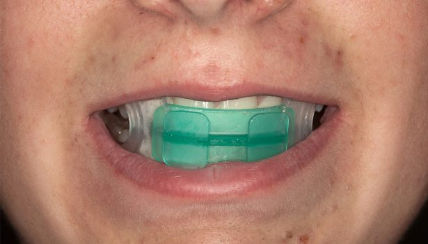 OWP_3_19_LECZENIE_PACJENTA_ROSNACEGO_Z_II_KLASA_SZKIELETOWA_FOT_9