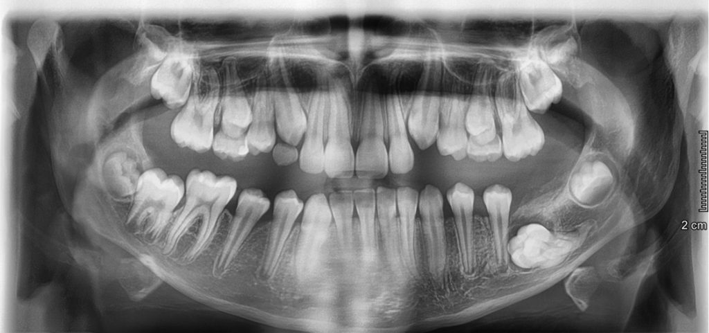 OWP_3_19_NIETYPOWA_POZYCJA_ZEBOW_W_ZUCHWIE_RYC_1