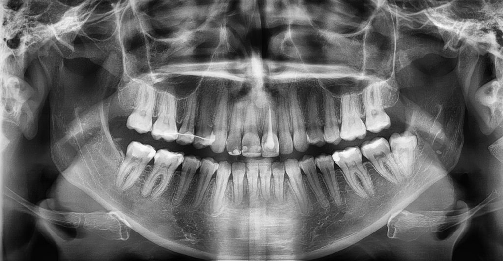 OWP_4_19_ZAKOTWIENIE_SZKIELETOWE_LECZENIE_ALIGNERAMI_RYC_7