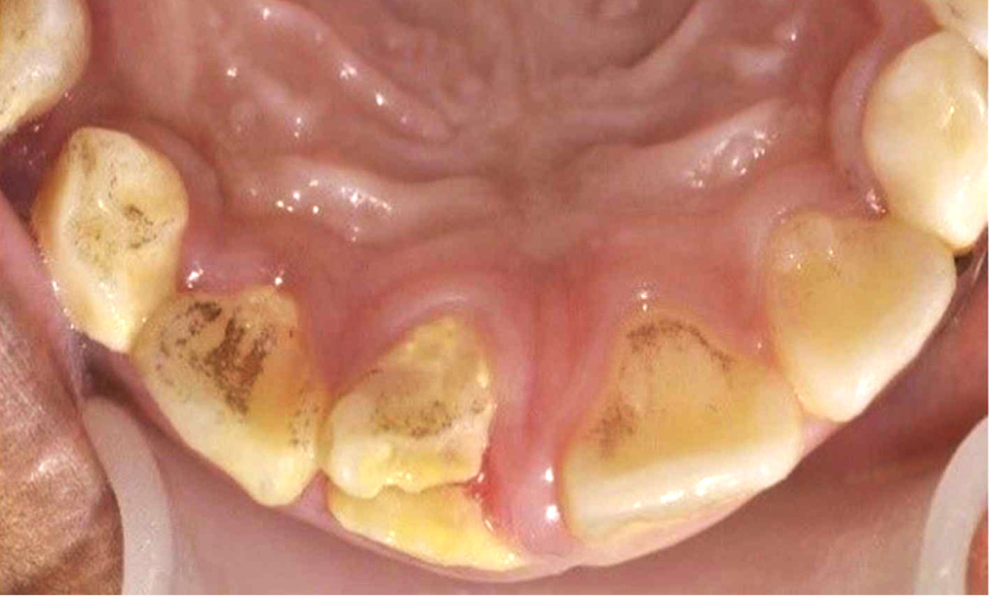 OWP_4_19_LECZENIE_ZEBOW_Z_POWIKLANYMI_ZLAMANIAMI_KORONOWO-KORZENIOWYMI_RYC_11