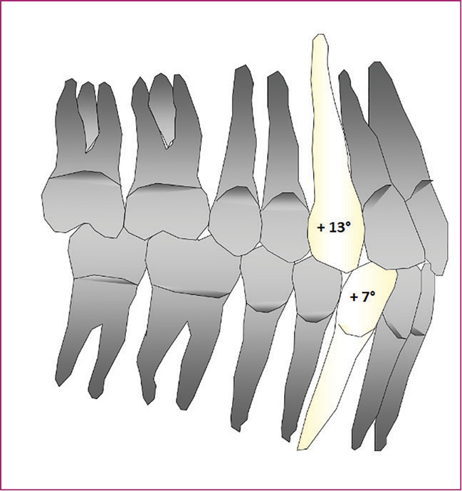 OWP_4_19_LECZENIE_LEKKIEJ_WADY_ZGRYZU_KLASY_III_RYS_1_A