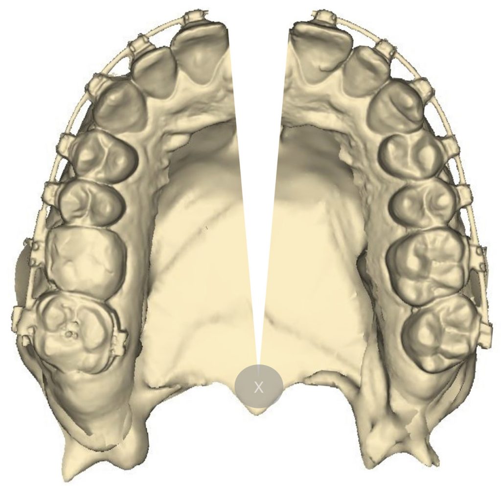 OWP_4_19_ZMIANY_PO_ZABIEGU_POSZERZENIA_SZCZEKI_RYC_3_A
